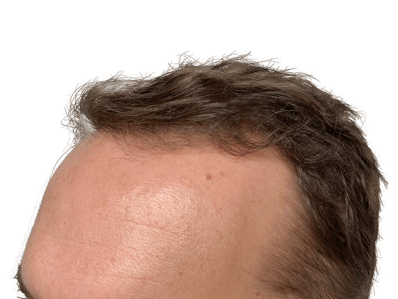 Thinning brown hair at hairline. Possible receding hairline before hair restoration treatment. Hair transplant candidate.