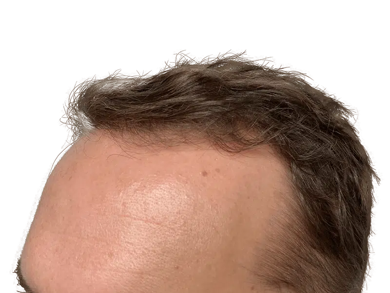 Thinning brown hair at hairline. Possible receding hairline before hair restoration treatment. Hair transplant candidate.