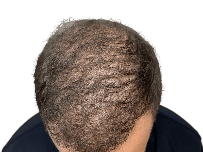 Before hair transplant: Thinning hair at crown and temples. Hair restoration candidate. Gray and brown hair.