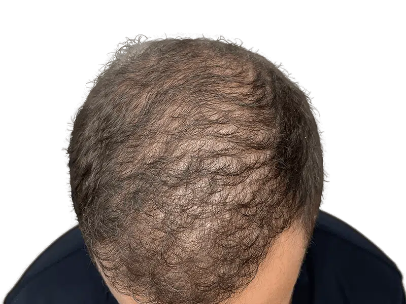Before hair transplant: Thinning hair at crown and temples. Hair restoration candidate. Gray and brown hair.