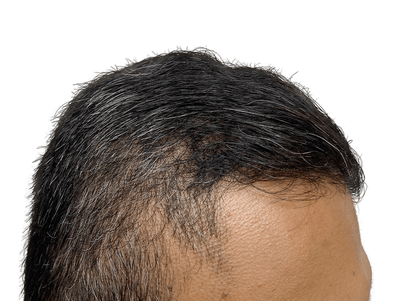Receding hairline & thinning hair. Potential hair transplant candidate. Before hair restoration treatment.