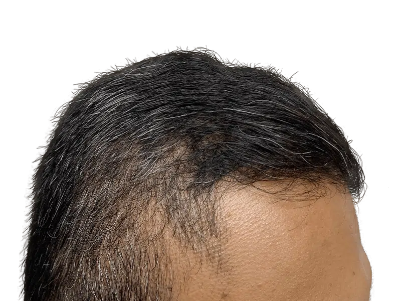 Receding hairline & thinning hair. Potential hair transplant candidate. Before hair restoration treatment.