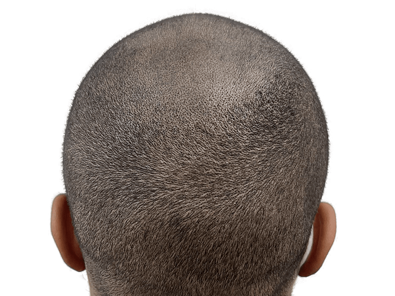 Close-cropped hair. Possible hair transplant candidate? Evaluate for hair restoration options and before/after results.