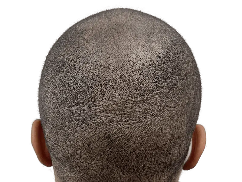 Close-cropped hair. Possible hair transplant candidate? Evaluate for hair restoration options and before/after results.