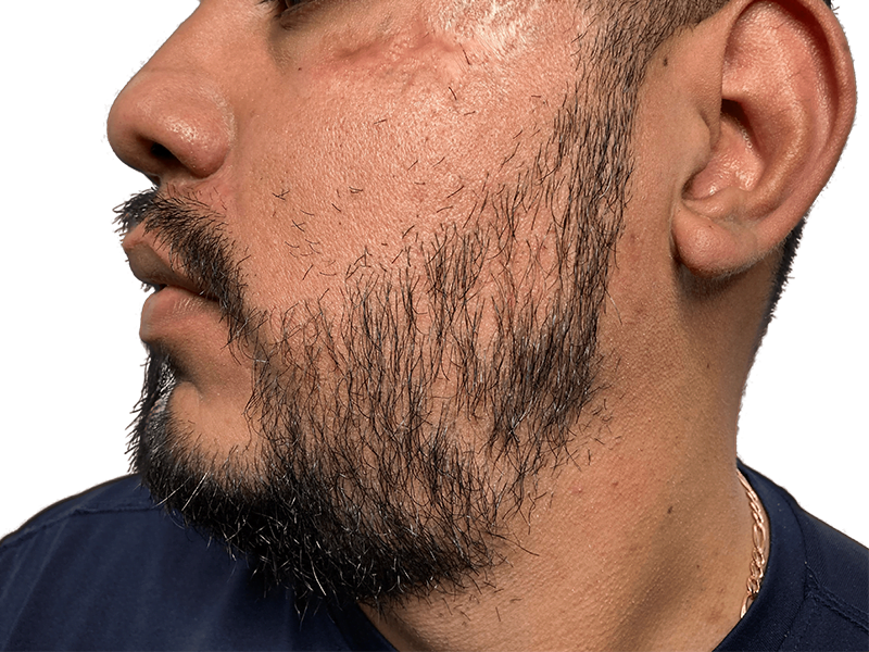 Beard transplant result: Hispanic man with fuller beard after hair restoration. Sparse to dense growth on cheeks.