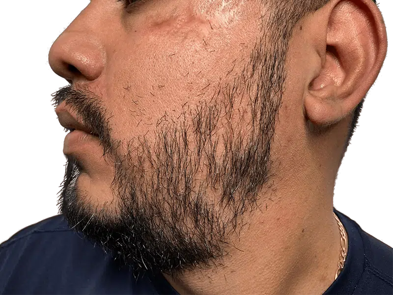 Beard transplant result: Hispanic man with fuller beard after hair restoration. Sparse to dense growth on cheeks.