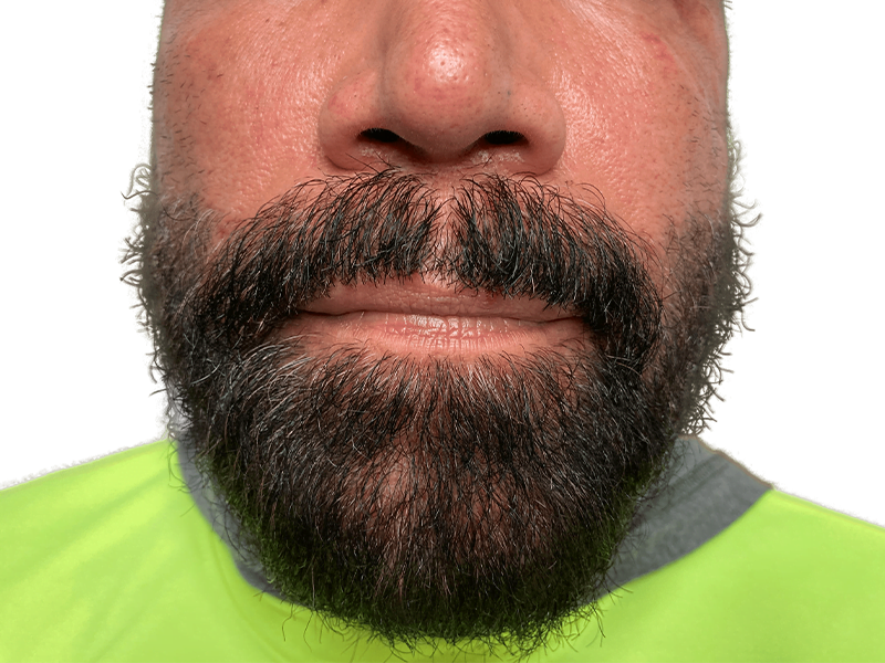 Thick beard and mustache. Example of facial hair growth, not a hair transplant result. Yellow shirt, fair skin.