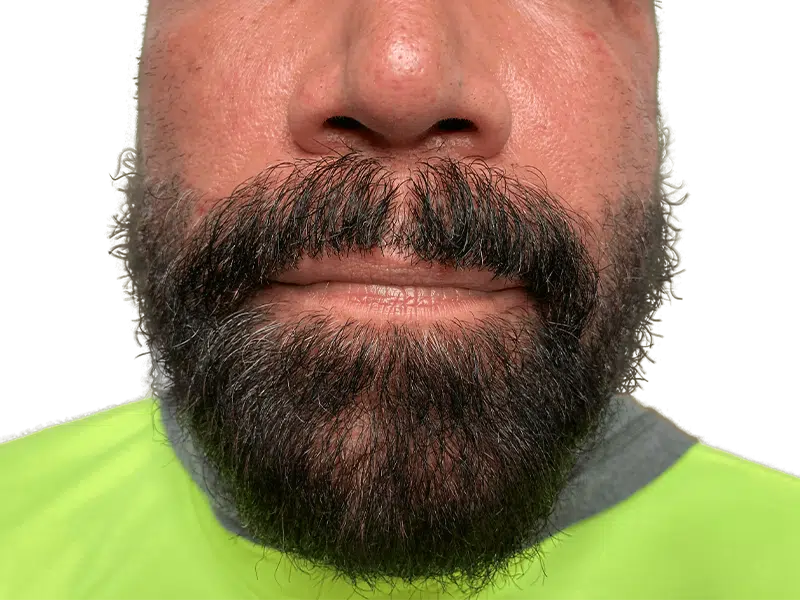 Thick beard and mustache. Example of facial hair growth, not a hair transplant result. Yellow shirt, fair skin.