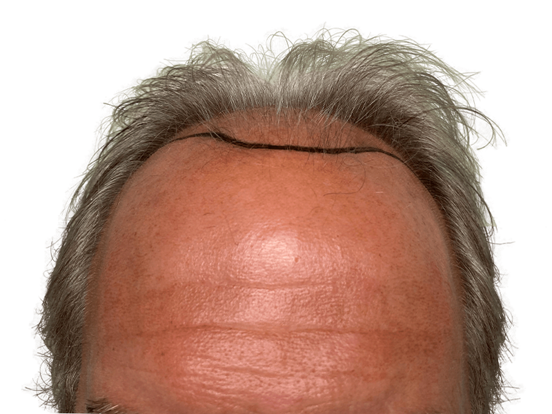 Hair transplant: Before & after hairline design. Graying hair, Caucasian male. Hair restoration procedure planning.