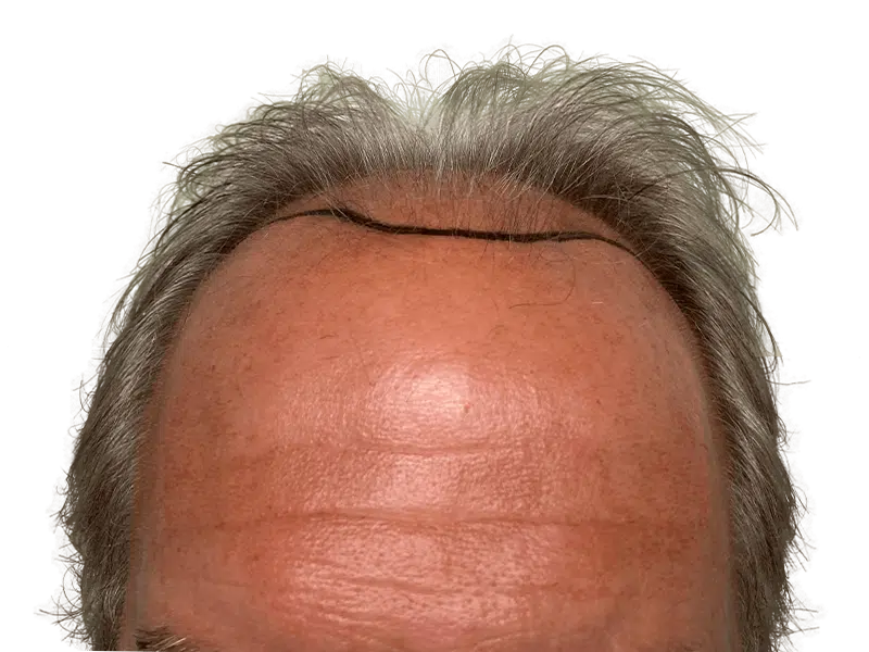 Hair transplant: Before & after hairline design. Graying hair, Caucasian male. Hair restoration procedure planning.