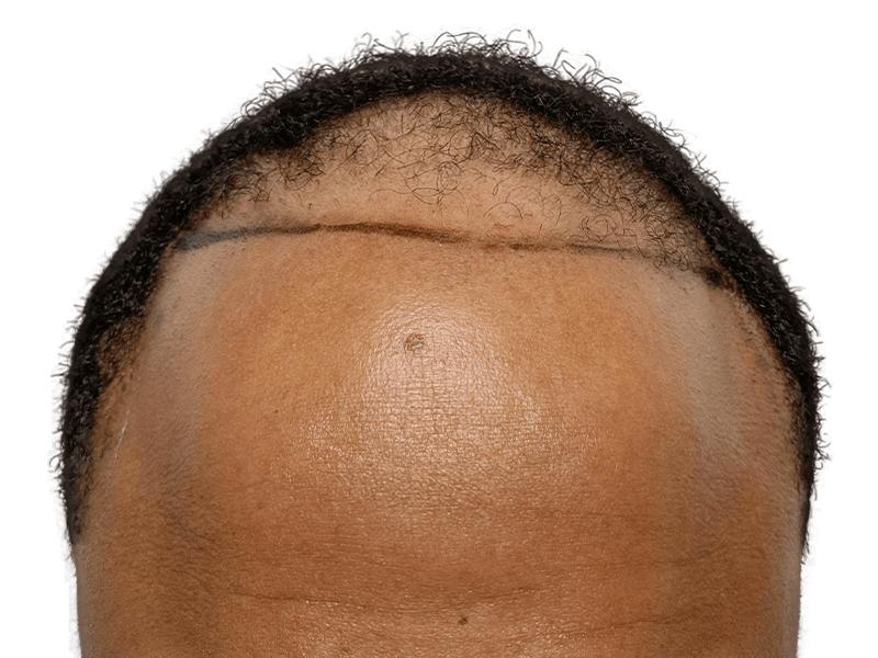 Hair transplant scar & receding hairline. Before/after hair restoration result for African American man.