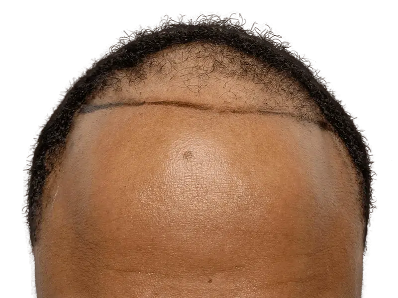 Hair transplant scar & receding hairline. Before/after hair restoration result for African American man.