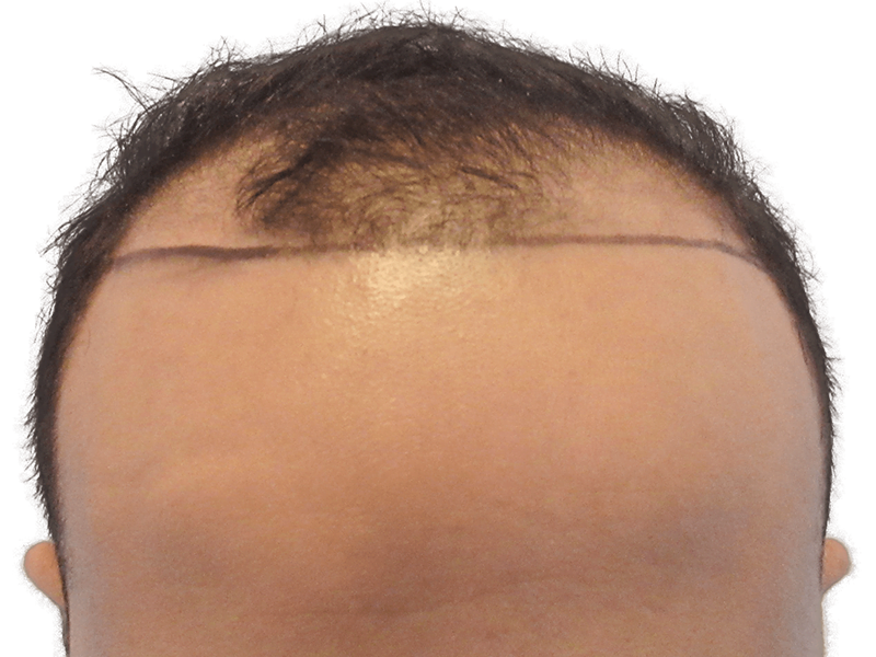 Receding hairline marked for hair transplant. Before procedure showing sparse hair and planned new hairline.