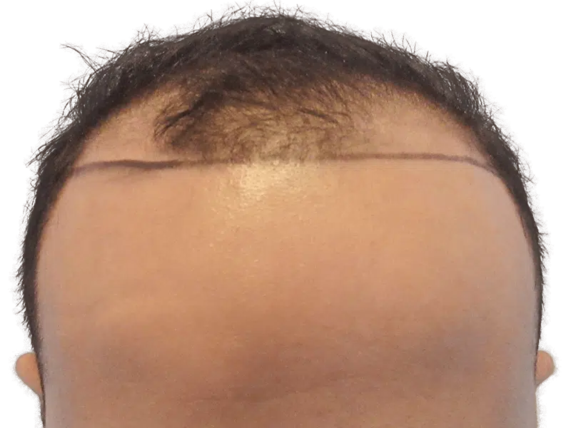 Receding hairline marked for hair transplant. Before procedure showing sparse hair and planned new hairline.