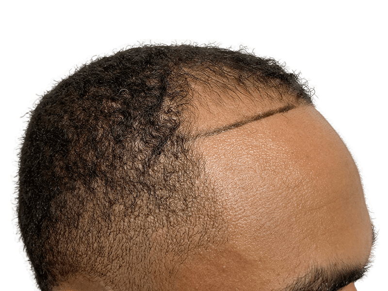 Hair transplant planning: African American man's hairline marked for restoration. Before & after hair loss solution.