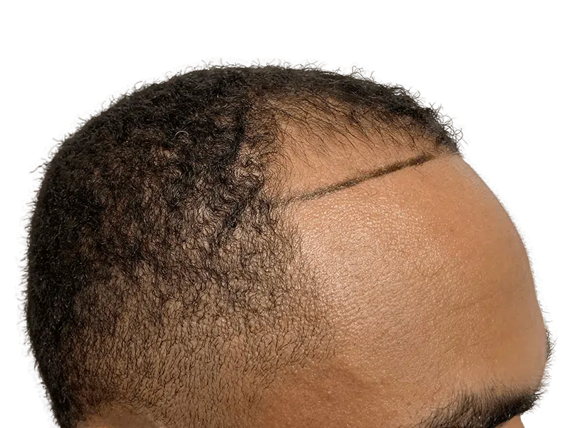 Hair transplant planning: African American man's hairline marked for restoration. Before & after hair loss solution.