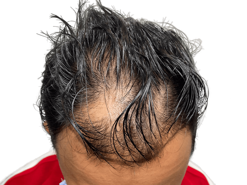 Thinning hairline. Potential hair loss before restoration. Hair transplant consultation? Asian/Hispanic descent.