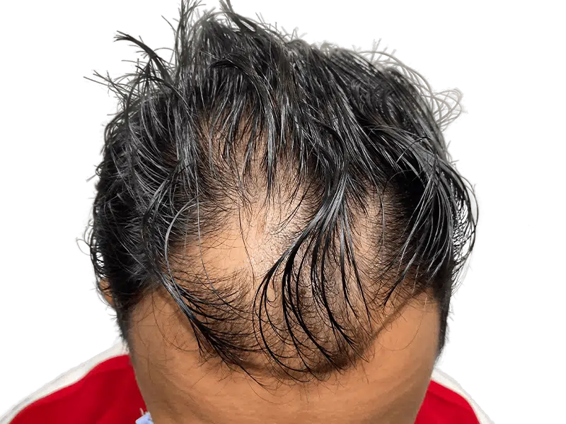 Thinning hairline. Potential hair loss before restoration. Hair transplant consultation? Asian/Hispanic descent.