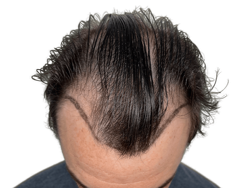 Receding hairline marked for hair transplant. Before procedure showing thinning and planned restoration area.