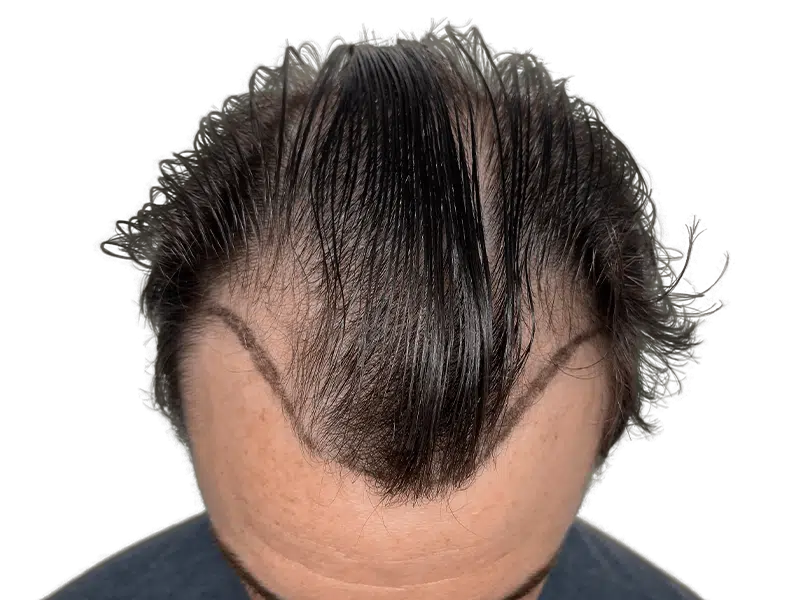 Receding hairline marked for hair transplant. Before procedure showing thinning and planned restoration area.
