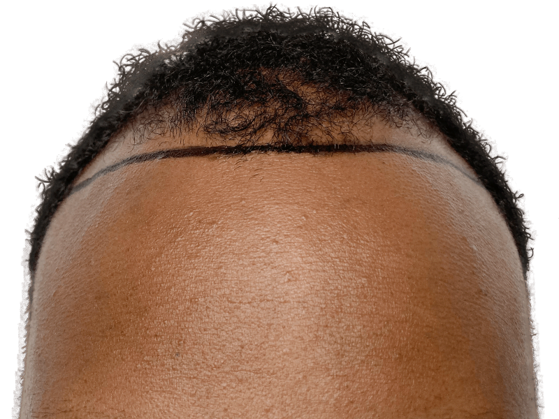 Hair transplant planning: African American man's receding hairline marked for restoration. Before procedure.