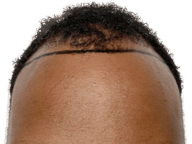 Hair transplant planning: African American man's receding hairline marked for restoration. Before procedure.