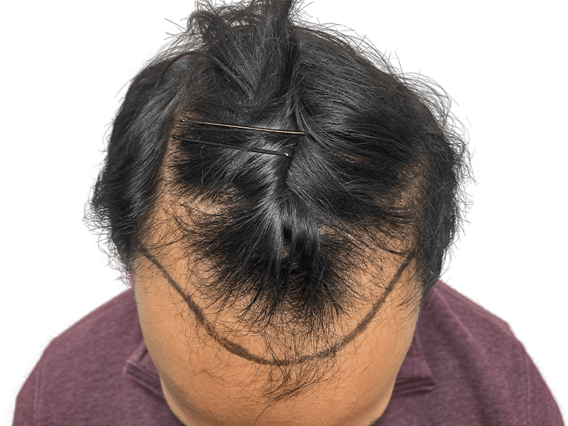 Hair transplant planning: Marked hairline on Asian man before hair restoration. Thinning hair, pre-procedure.
