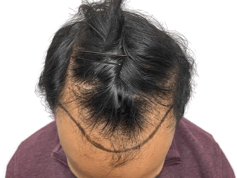 Hair transplant planning: Marked hairline on Asian man before hair restoration. Thinning hair, pre-procedure.
