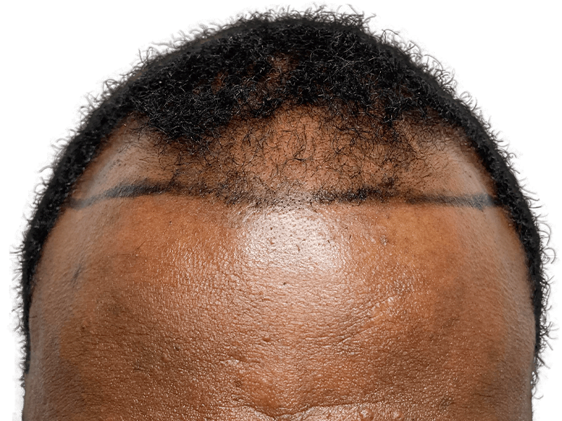 Hair transplant planning on African American man. Marked hairline shows before/after area for hair restoration.