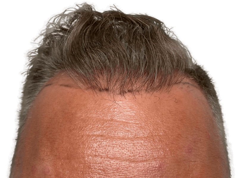 Hair transplant result: Graying Caucasian man's hairline with new growth. Before & after hair restoration example.