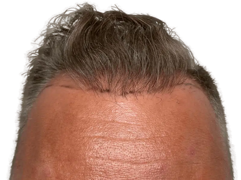 Hair transplant result: Graying Caucasian man's hairline with new growth. Before & after hair restoration example.