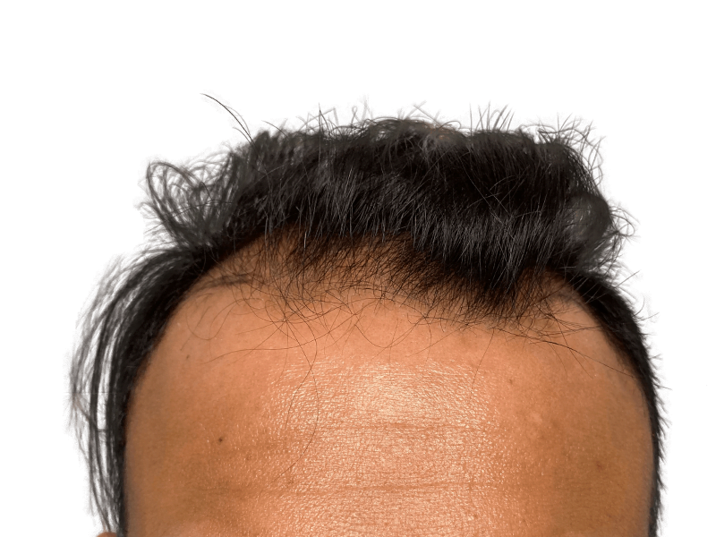 Hair transplant result: Asian man's hairline after restoration. Dark hair, improved density. Before/after potential.