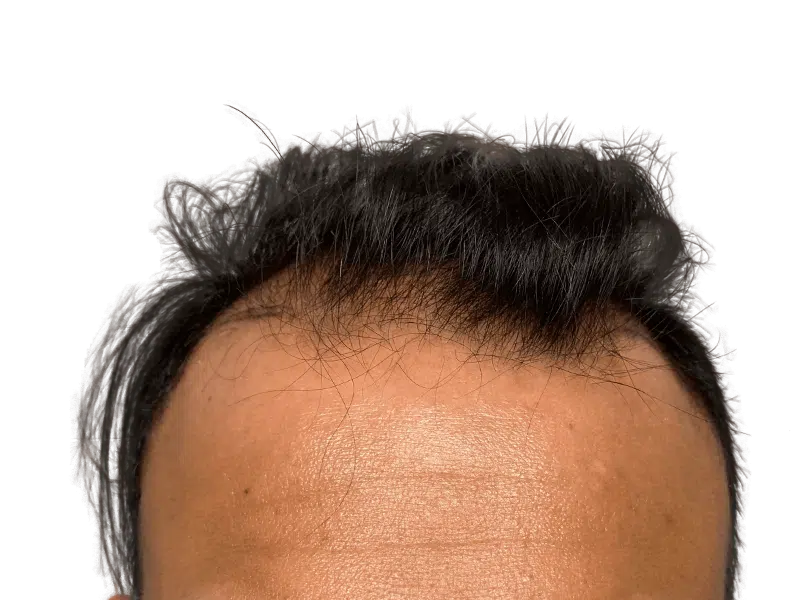 Hair transplant result: Asian man's hairline after restoration. Dark hair, improved density. Before/after potential.