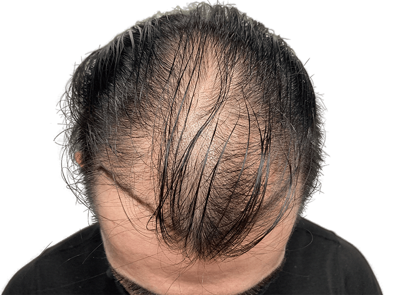 Thinning, dark hair on top of head. Possible hair loss candidate. Consider hair restoration options.