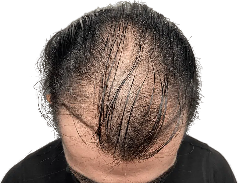 Thinning, dark hair on top of head. Possible hair loss candidate. Consider hair restoration options.