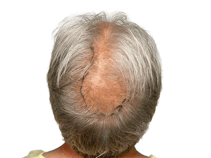 Hair thinning before hair restoration. Crown balding, graying hair. Potential hair transplant before/after result.