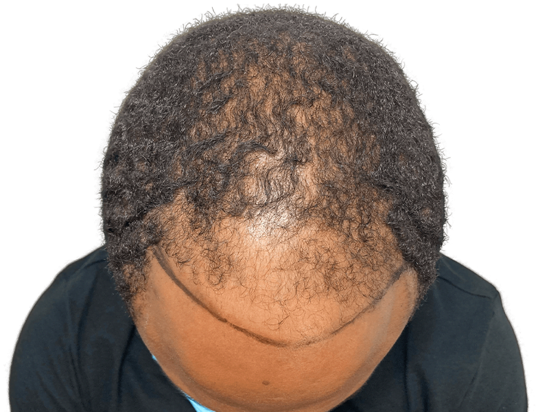 Before hair transplant: Thinning hairline marked on Black male. Hair restoration procedure planning.