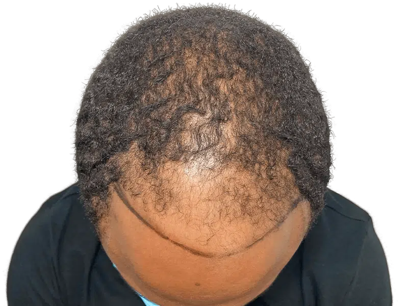 Before hair transplant: Thinning hairline marked on Black male. Hair restoration procedure planning.