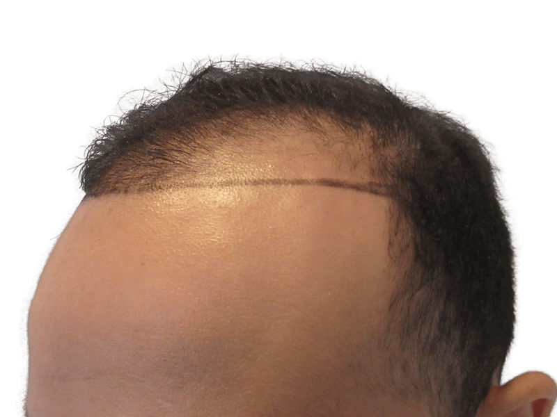 Hair transplant before & after. Asian/Middle Eastern man with receding hairline. Hair restoration results.