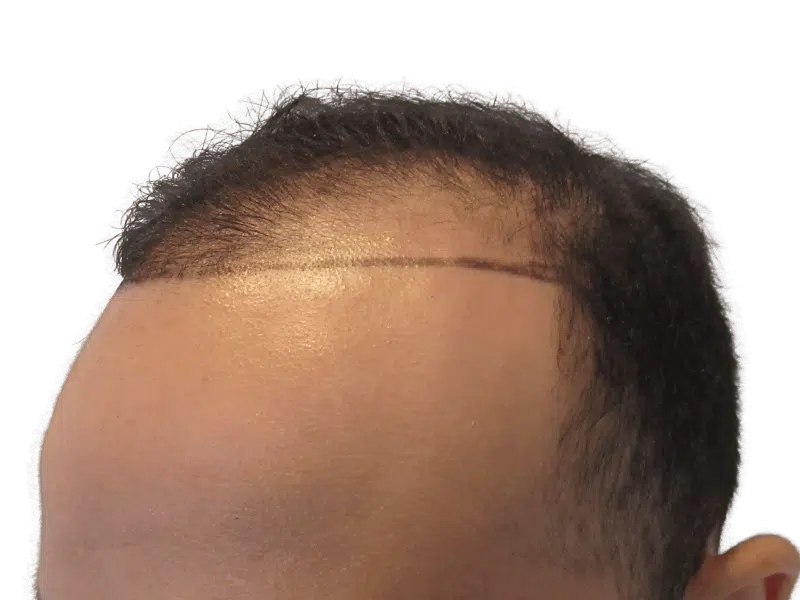 Hair transplant before & after. Asian/Middle Eastern man with receding hairline. Hair restoration results.
