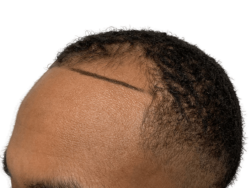 Hair transplant: African American man's hairline marked for restoration. Before/after potential shown. Hair restoration results.