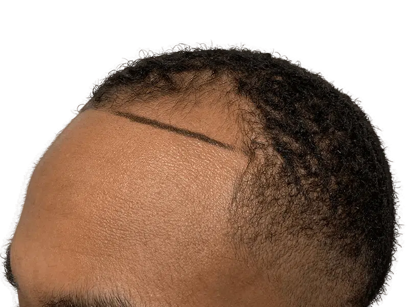 Hair transplant: African American man's hairline marked for restoration. Before/after potential shown. Hair restoration results.