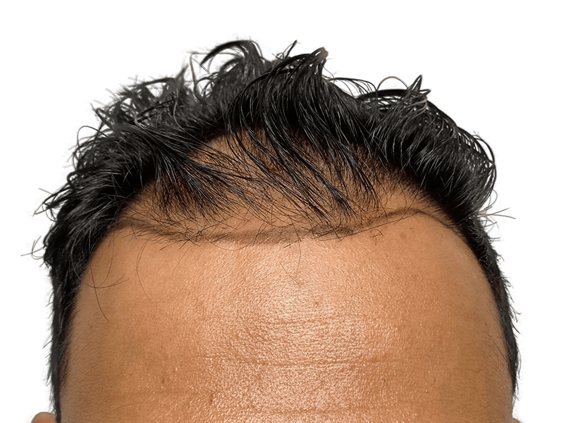 Hair transplant result: Asian man's restored hairline. Before & after hair restoration procedure. Dense, natural-looking hair growth.