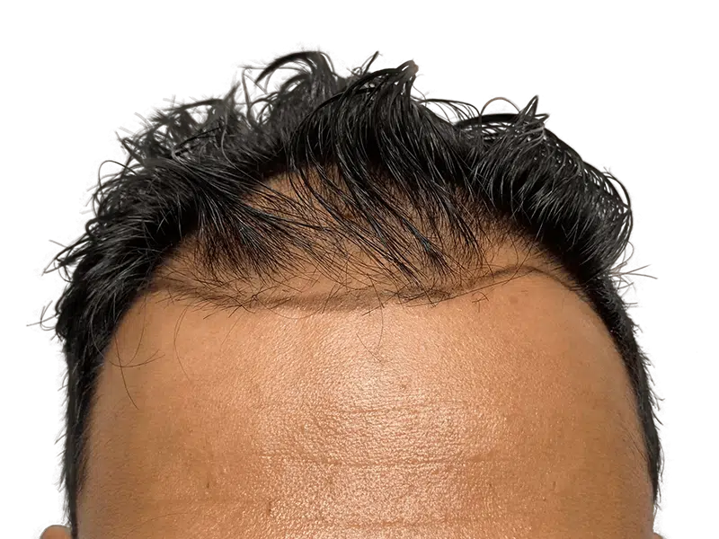 Hair transplant result: Asian man's restored hairline. Before & after hair restoration procedure. Dense, natural-looking hair growth.