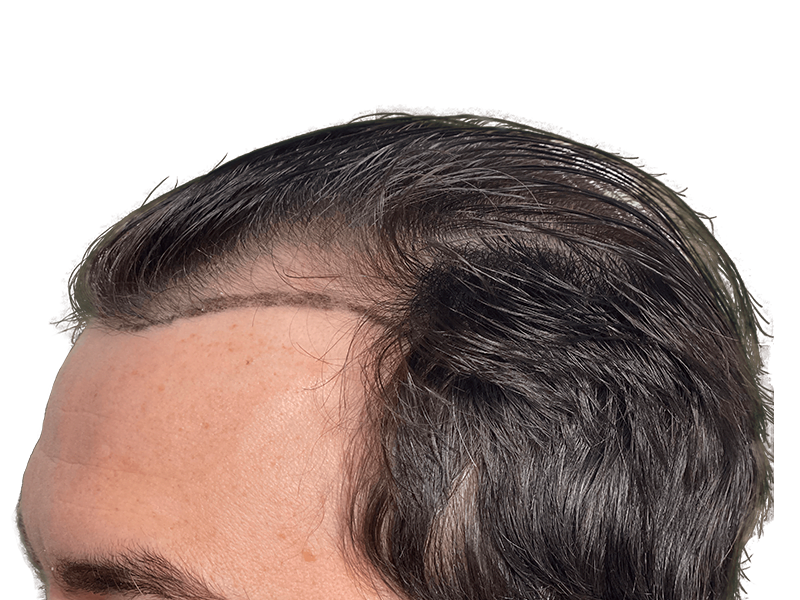 Hair transplant before & after. Restored hairline with denser, natural-looking hair. Hair restoration results.