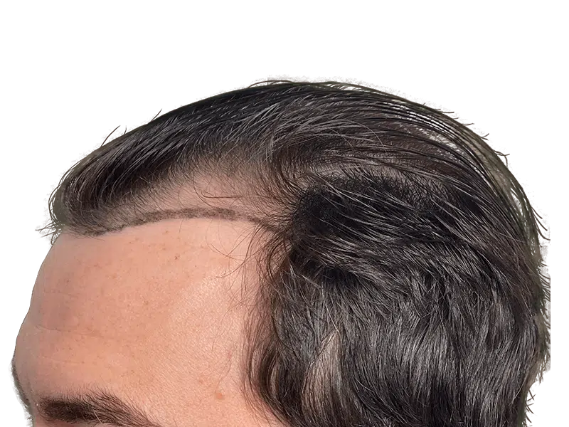 Hair transplant before & after. Restored hairline with denser, natural-looking hair. Hair restoration results.
