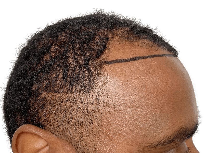 Hair transplant planning: African American man's hairline marked for restoration. Before hair loss treatment.