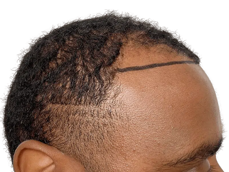 Hair transplant planning: African American man's hairline marked for restoration. Before hair loss treatment.