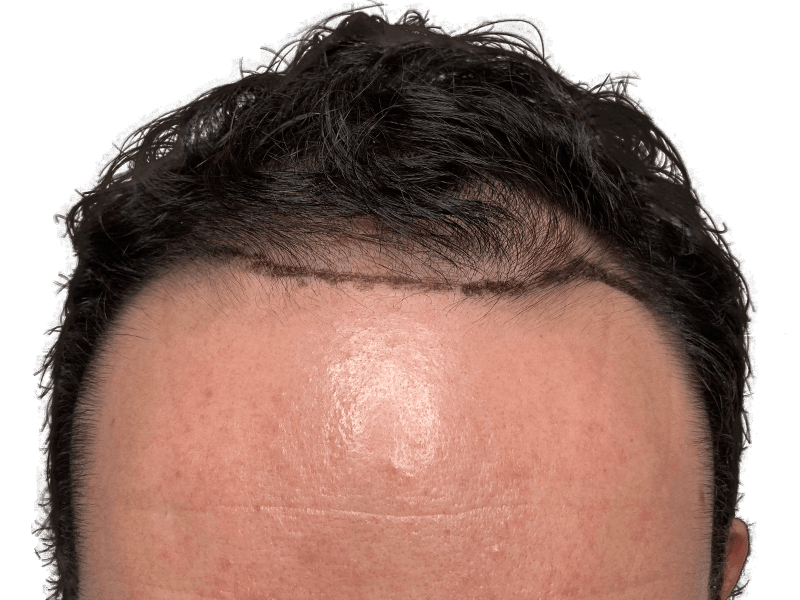 Hair transplant results: Man's fuller hairline after restoration. Before/after visible. Hair restoration success.