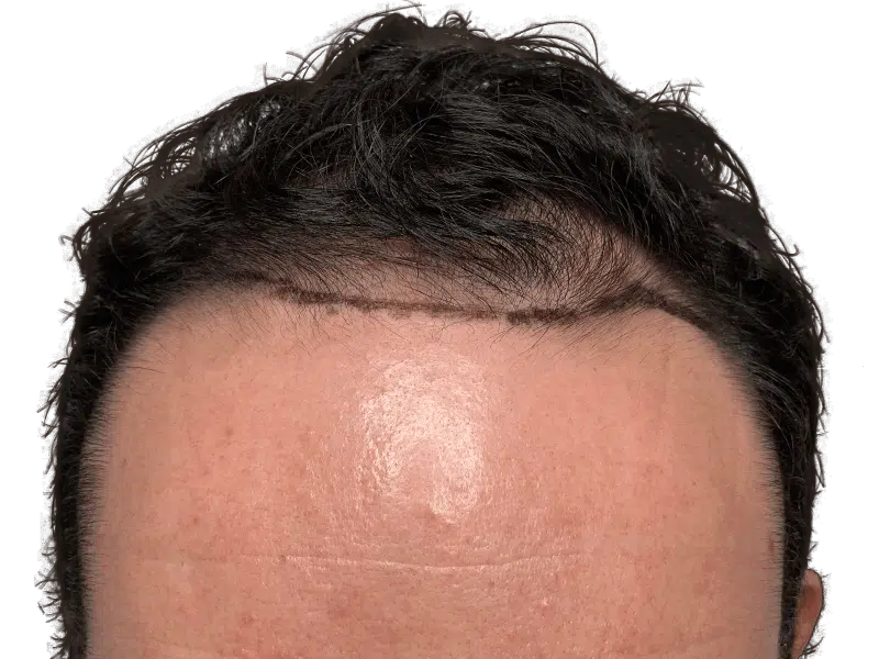 Hair transplant results: Man's fuller hairline after restoration. Before/after visible. Hair restoration success.